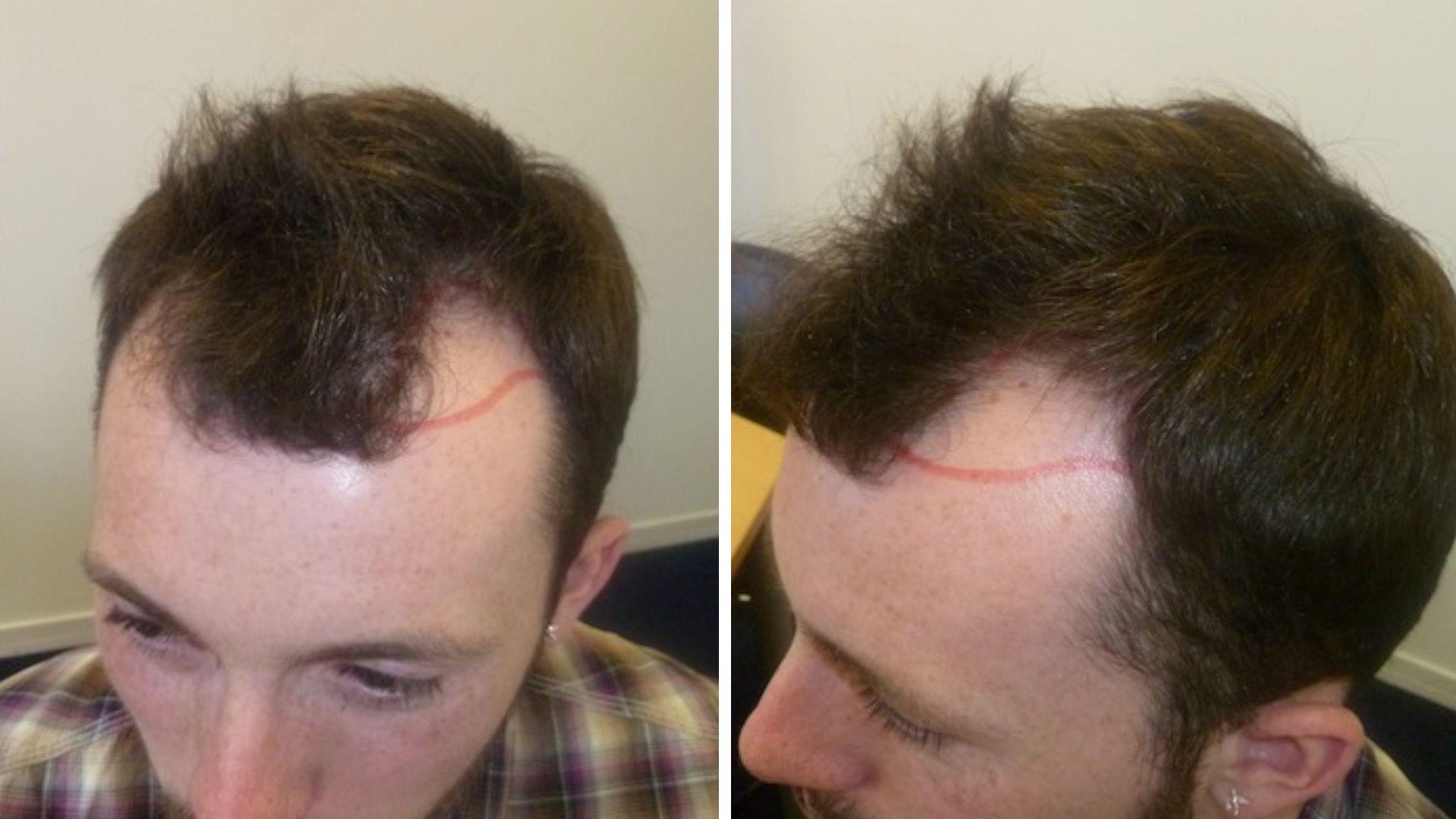 Hair Transplant UK – The Nation’s Trusted Name in Hair Restoration